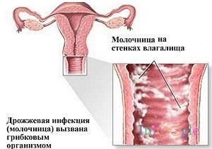 Молочниця (кандидоз) у жінок і чоловіків опис, симптоми, причини