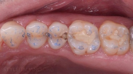Покроковий протокол реставрації дистальних зубів