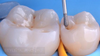 Покроковий протокол реставрації дистальних зубів