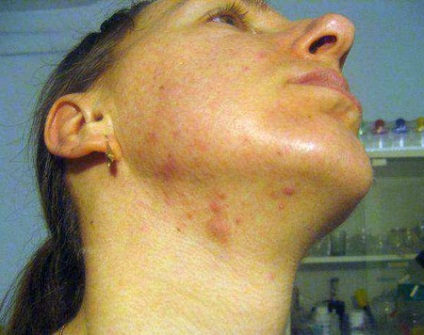 Причини прищів на шиї у жінок і чоловіків
