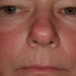 Розацеа на обличчі симптоми, причини, фото і лікування