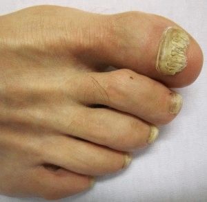 Ванночки від грибка нігтів на ногах рецепти і профілактика