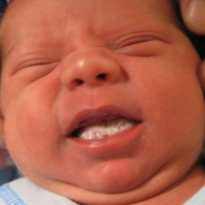 Молочниця (дріжджовий стоматит) у дитини - симптоми і лікування народними засобами в домашніх