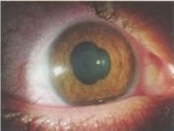 Uveita – inflamatia ochiului, cauze, tratament – prajituri-cluj.ro