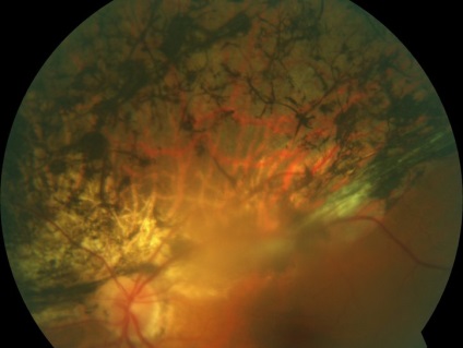 Причини абіотрофіі сітківки ока у дітей і дорослих - діагностика і лікування патології