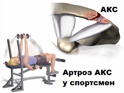 artroza articulației acromioclaviculare caise uscate pentru dureri articulare