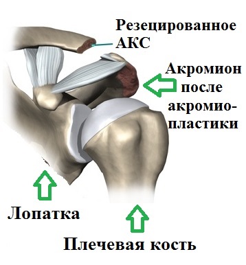 artroza acromioclaviculară a articulației umărului)