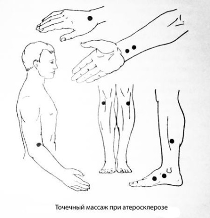 Атеросклероз судин ніг причини і лікування