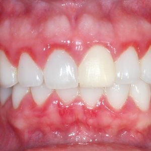 Гінгівіт причини розвитку, симптоми, лікування гінгівіту в кабінеті у стоматолога і народними