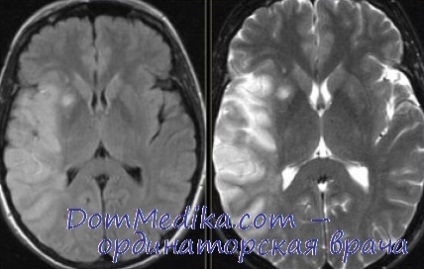 Магнітно-резонансна томографія (МРТ) при ішемії головного мозку