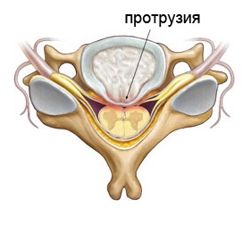 Методи лікування протрузії міжхребцевого диска