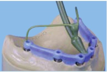 Первинні конструкції при протезуванні на імплантатах
