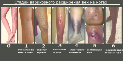 pigmentarea pielii în varicoza)