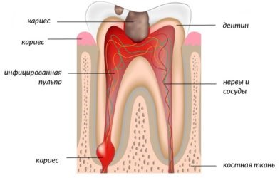Пульпіт зуба види, симптоми і методи лікування