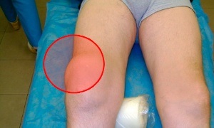 Гігрома колінного суглоба - клінічна картина і лікування