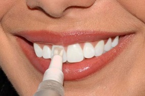 Відбілювання зубів в П'ятигорську ціни, контакти клінік