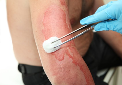 Отруєння шкіри отрути, мазі, кислоти та технічні рідини викликають отруєння шкіри
