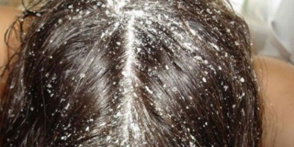 Сольовий скраб для шкіри голови відгуки про рецепт соляного кошти для волосся з морської солі і як