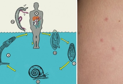 Сверблячка купальщика які водні паразити можуть вражати шкіру