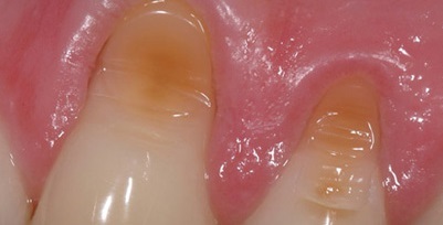 Клиновидний дефект зубів фото, причини і лікування