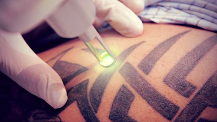 Лазерне видалення татуювання - студія татуювань white hawk
