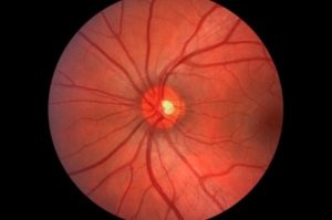 Лікування гліоми зорового нерва в Ізраїлі, провідні клініки