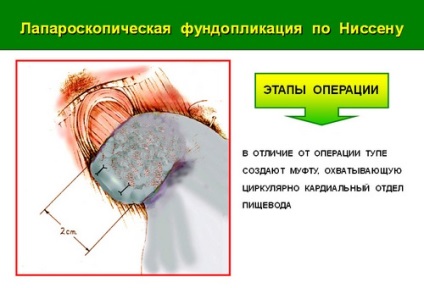 Малоінвазивне (лапароскопічне) хірургічне лікування гриж стравохідного отвору діафрагми