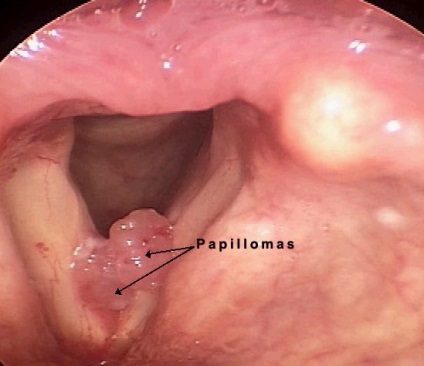 papilomatoza laringelui cum se tratează)
