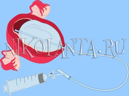 Керована балонна тампонада для зупинки внутрішньоматкового кровотечі