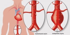 Аневризма черевної аорти як лікувати