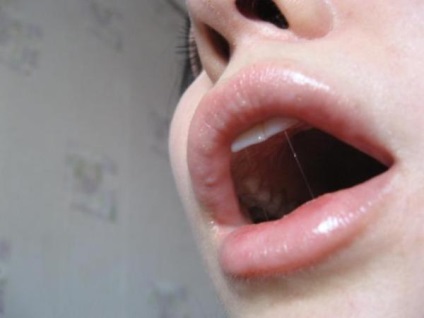 Асиметрія губ після збільшення що робити