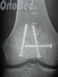 Перелом надколінка симптоми, лікування, операція, реабілітація, перелом колінної чашечки