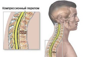 Перелом шийного відділу хребта - лікування переломів шийного відділу, реабілітація