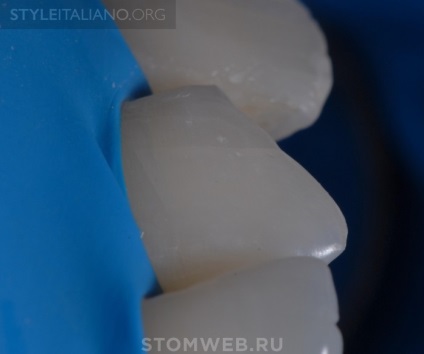 Stomweb - стаття - поради і рекомендації як зробити краю реставрацій на передніх зубах невидимими