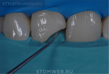 Stomweb - стаття - поради і рекомендації як зробити краю реставрацій на передніх зубах невидимими
