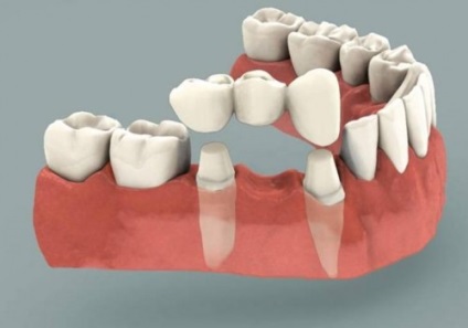 Зубний міст установка, процедура, догляд і вартість, цілодобова стоматологія в москві