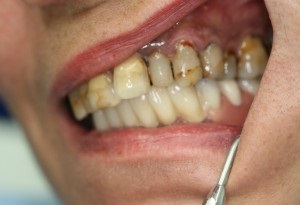 Як куріння впливає на здоров'я порожнини рота, блог клініки dentaprime
