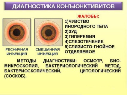 Кон'юнктивіт очей лікування у дорослих, краплі, симптоми, вірусний