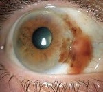 Пігментна глаукома - причини, симптоми, діагностика та лікування