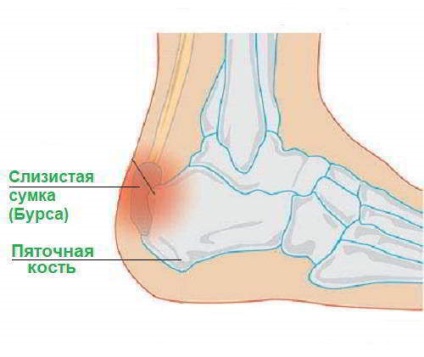 bursita de calcai dureri articulare ale piciorului în îndoirea piciorului