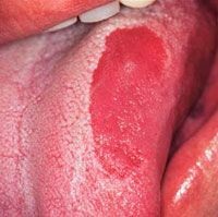 Глоссит - симптоми, лікування народними засобами і антибіотиками