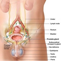 Gimnastica si sport cu prostatita si adenom de prostata - Carcinomul