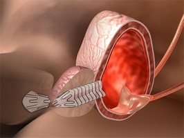 prostatitis diagnosis ct scan cum să tratezi prostatita hr