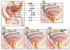 biopsia de próstata por fusión