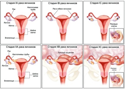Рак яєчників у жінок