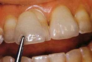 Вініри на зуби ціни і види, установка винира на передній зуб в москві