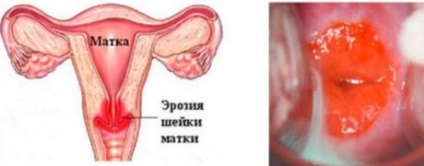 negii cervicali ectopia colului uterin