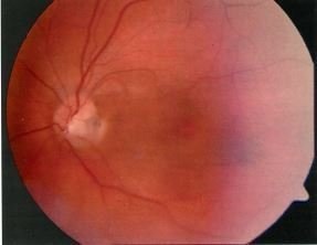 Клінічна оптична когерентна томографія ямка зорового нерва