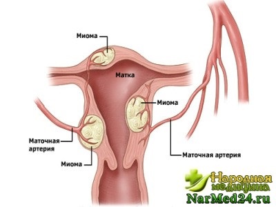 Міома матки причини її виникнення, симптоми і способи лікування народними засобами
