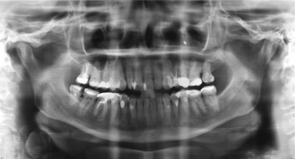 Чи можна робити МРТ з імплантами зубів і які обмеження